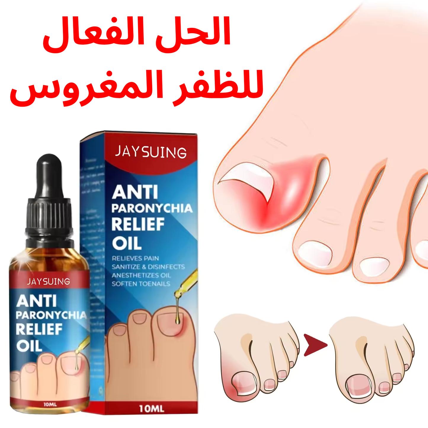 زيت مضاد للظفر المغروس